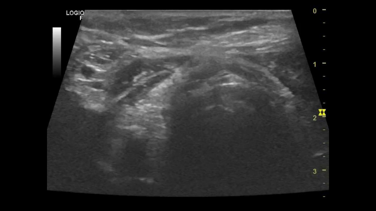 Микрокальцинаты молочной железы рентген. Микрокальцинаты в молочной железе на маммографии. Узел с кальцинатами что это. Кальцинированная киста щитовидной железы. Гемангиома щитовидной железы на узи.