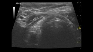 Кальцинат щитовидной железы