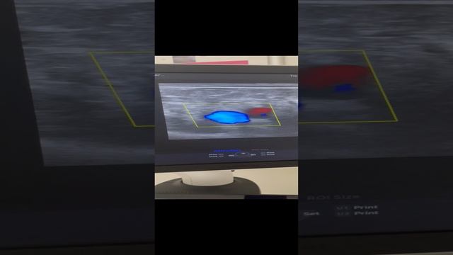 Контрольное Узи вен после операции удаления варикоза. Флеболог Москва. Флеболог. Сосудистый хирург смотреть онлайн