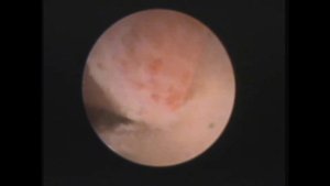 полип в ухе