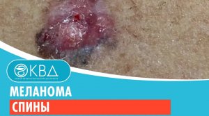 ? Меланома спины. Клинический случай №771