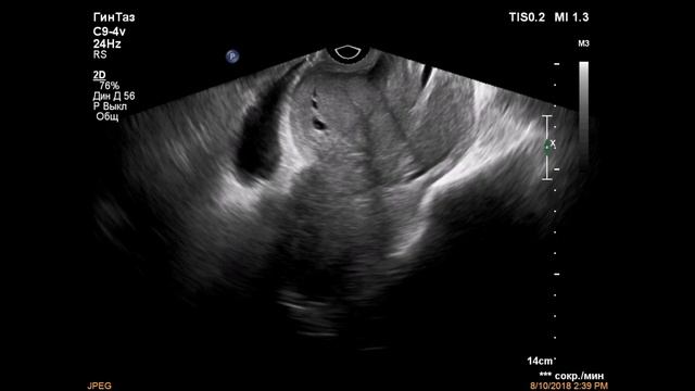 Рак шейки матки смотреть онлайн