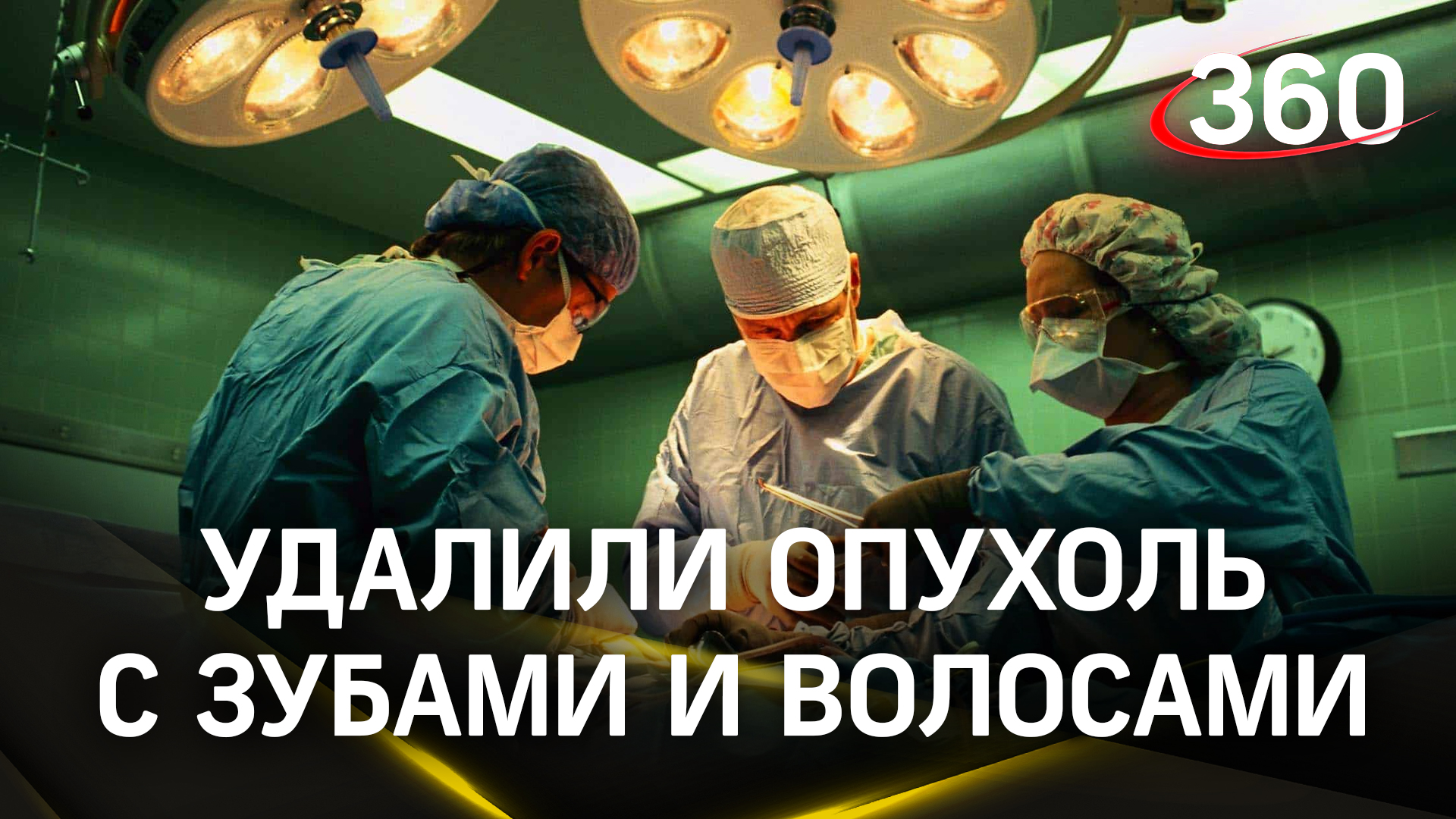 Извлекли опухоль с зубами и волосами. Врачи в Домодедове спасли пациентку с разорвавшейся кистой