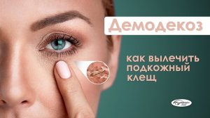 ДЕМОДЕКОЗ: как распознать и избавиться от клеща