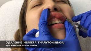 Удаление геля из губ. ГИАЛУРОНИДАЗА ЛИДАЗА