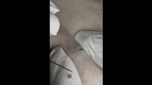 Чистка лица. Прыщи, угри и чёрные точки. Face cleaning. Pimples, blackheads, and black dots.