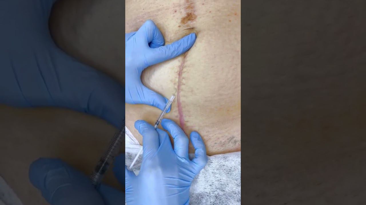 #Ботокс #Диспорт в лечении рубцов смотреть онлайн