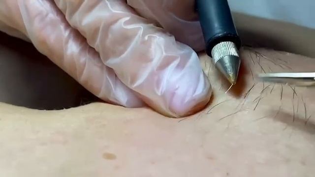 Электроэпиляция удаление волос НАВСЕГДА. Татьяна 89252955525 смотреть онлайн