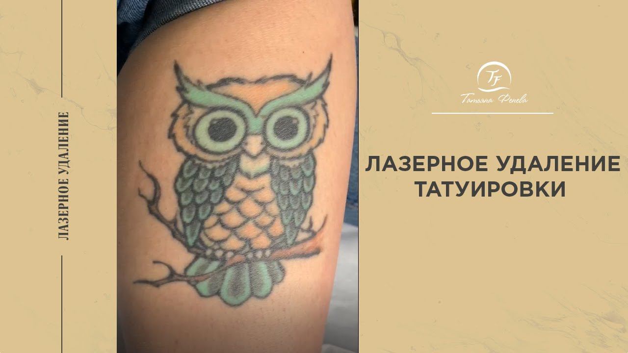 Лазерное удаление татуировки