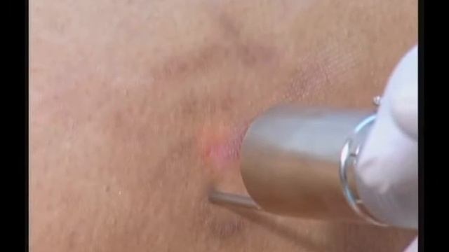 FT лазерное удаление растяжек. Ч.2 смотреть онлайн