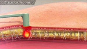 Малоинвазивная радиочастотная липосакция и лифтинг FaceTite в Пятигорске