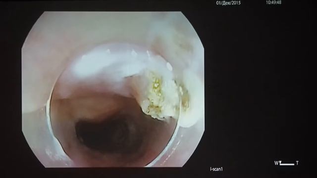 КС 01 Rehan Haidry Кишечная метаплазия верхней трети пищевода АПК смотреть онлайн