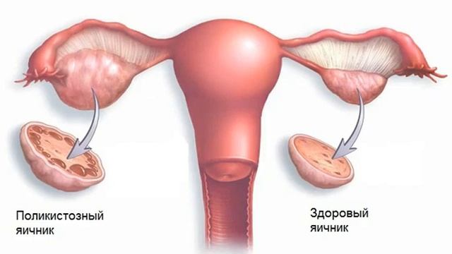 СИНДРОМ ПОЛИКИСТОЗНЫХ ЯИЧНИКОВ ДИАГНОСТИКА И ЛЕЧЕНИЕ смотреть онлайн