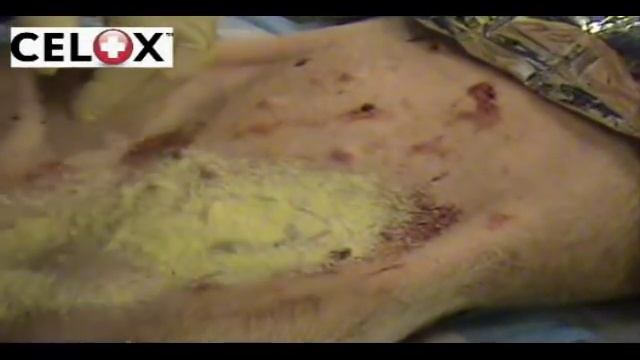 Celox Haemostatic Agent смотреть онлайн