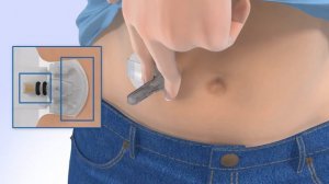 Inserting the Guardian™ Sensor 3