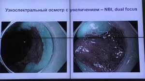 10Случай Матвиенко НА Пищевод Барретта на фоне рефлюкс эзофагита и ГПОД