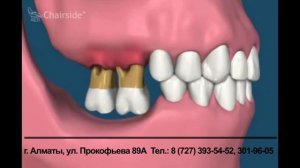 Последствия отсутствия  протезирования зубов