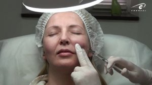 Коррекция носогубной складки канюлей