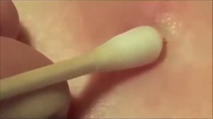 Как удалить клеща безболезненно ватной палочкой