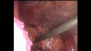 Лапароскопическая предбрюшинная паховая герниопластика справа