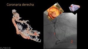 Coronariografía  y anatomía quirúrgica de la arteria coronaria derecha