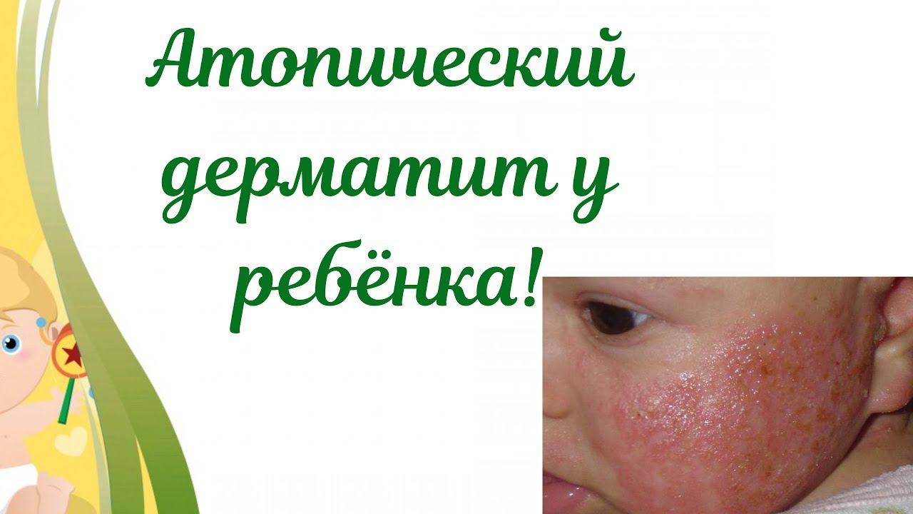 Атопический дерматит у ребёнка!Как маме помочь самой малышу! смотреть онлайн