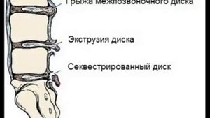 Экструзия межпозвонкового диска