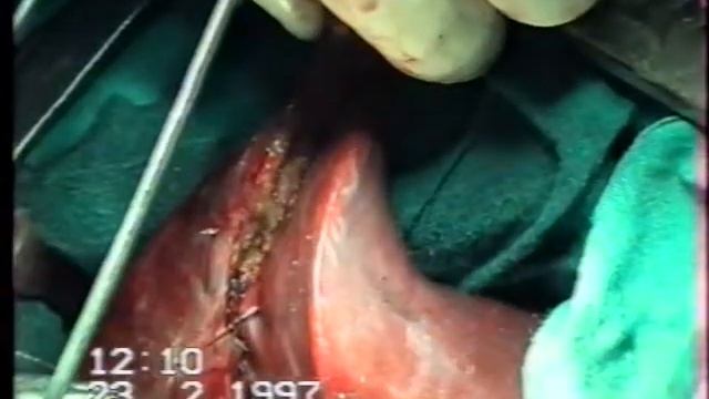 Острый гангренозный калькулёзный холецистит.Эмпиема желчного пузыря