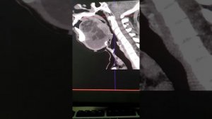 Кт шеи! Киста шеи ! Киста под языком! Срелинная киста шеи !