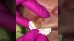 Гнойник на щеке.