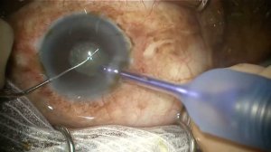 Chirurgie de cataracte (floppy iris syndrome)