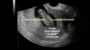 Ультразвуковая анатомия плода в I триместре беременности