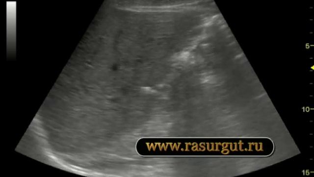 кальцинаты печени.mp4 смотреть онлайн