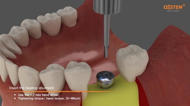 TSIII fixture with Rigid Abutment_eng(Surgical & Prothesis sequence) смотреть онлайн