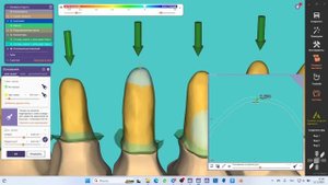 Небольшой ликбез по цементному зазору в exocad