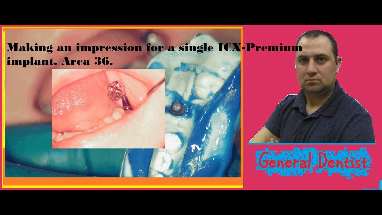 Making an impression for a single ICX-Premium implant. Area 36.