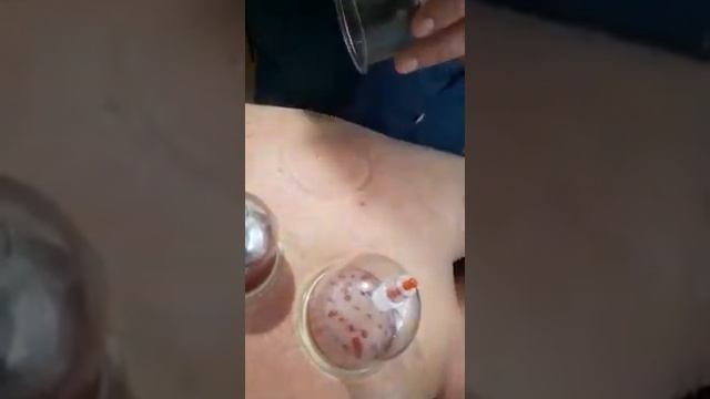 ЦЕЛИТЕЛЬ ХАЗЕИН(Хиджама кровопускание)
