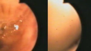 Атрофический бронхит. Гибкая бронхоскопия. Череповец.