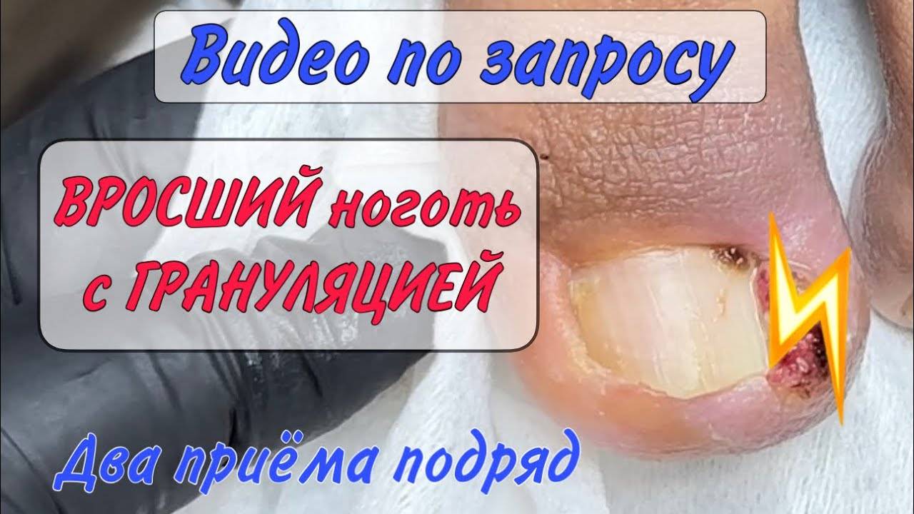 ⚡️Вросший ноготь _ дикое Мясо _ Гипергрануляция