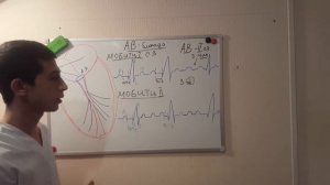 АТРИОВЕНТРИКУЛЯРНАЯ БЛОКАДА НА ЭКГ!!!