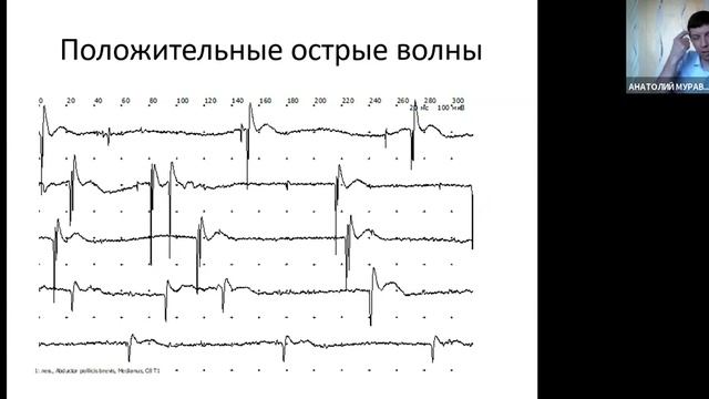 Игольчатая электромиография (ЭМГ) | Вебинар Нейрософт смотреть онлайн