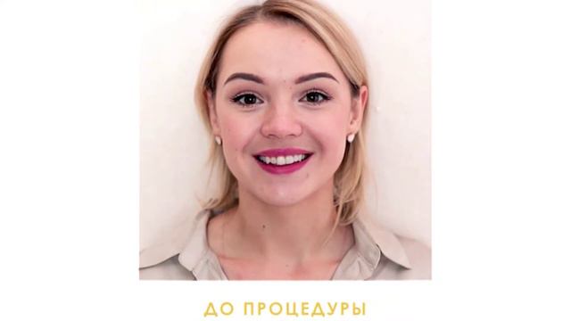 Преображение улыбки с помощью виниров