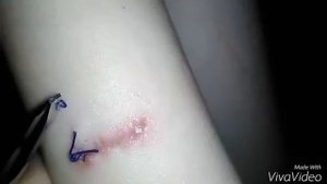 Снятие швов.