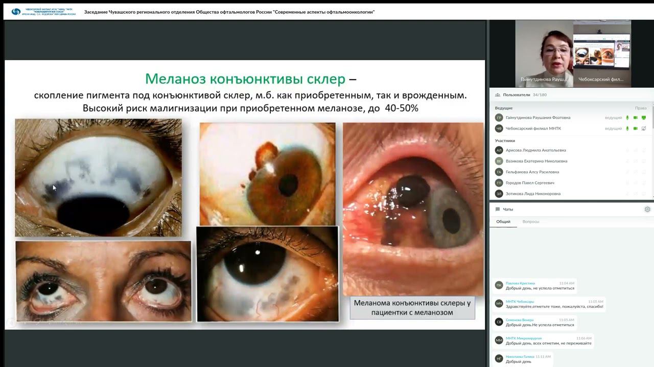 Заседание РООР Современные аспекты офтальмоонкологии 27 10 2023 смотреть онлайн