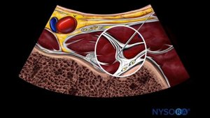 Hip Block - NYSORA's Reverse Ultrasound™ Animation