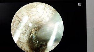 Quloq chirkini quruq usulda tozalash.(sera)