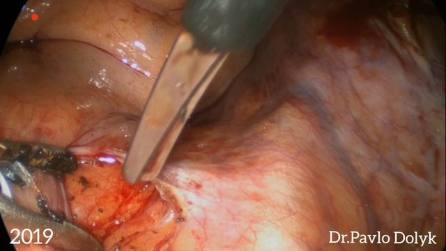 Detection of the promotorium ( Детекція промонторіуму для фіксації культі піхви ) смотреть онлайн