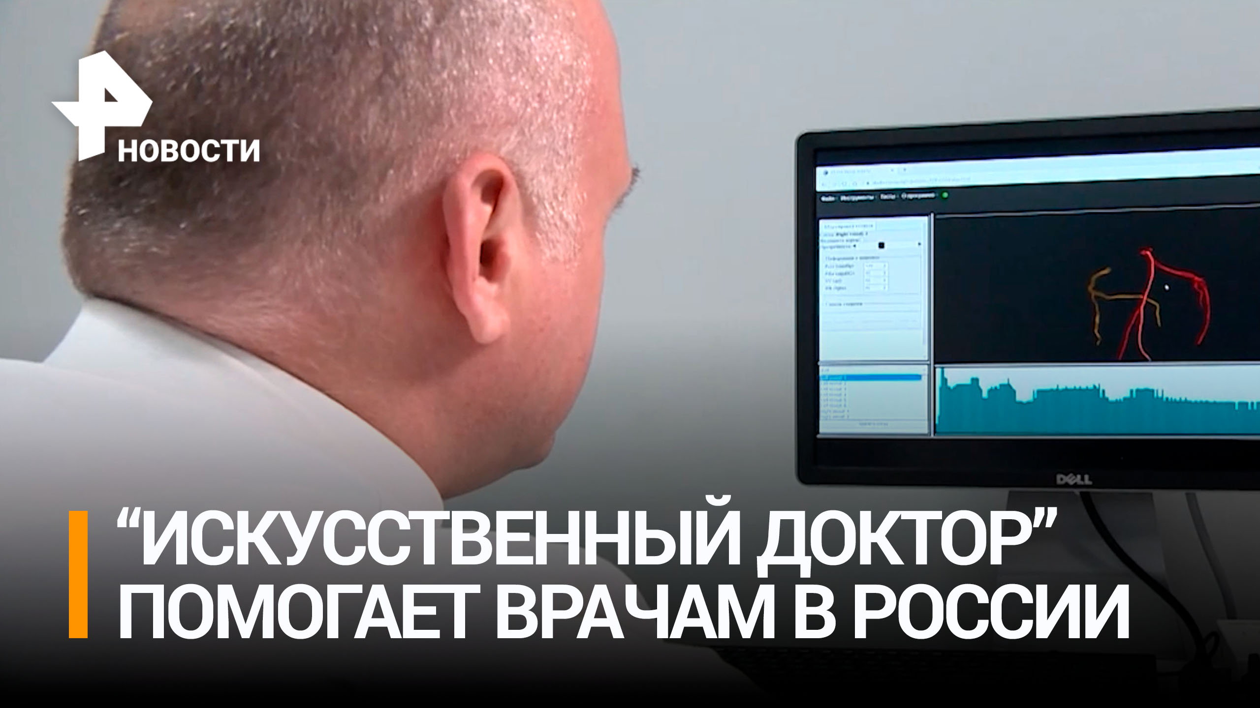 Инновативный искусственный интеллект помогает российским врачам в диагностике / РЕН Новости