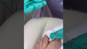 Удаление вросшего ногтя без анастезии