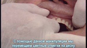 съёмный протез на мини-имплантах - верхняя челюсть